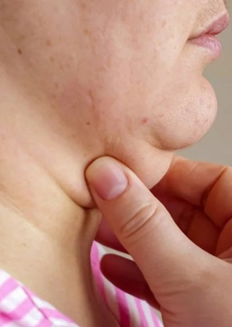 ساکشن غبغب انجام دادی این کارا یادت نره انجام بدی...! | دکتر سمیرا حسینی متخصص گوش حلق بینی