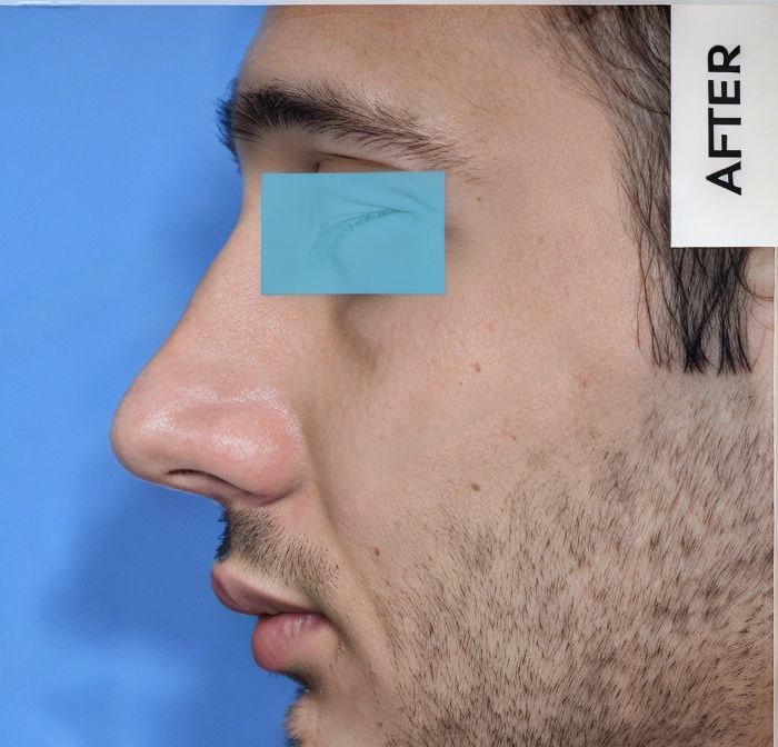 جراحی زیبایی بینی