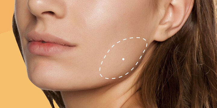 بوکال فت و مواردیکه احتمالا نمیدانستید! | دکتر سمیرا متخصص گوش حلق بینی