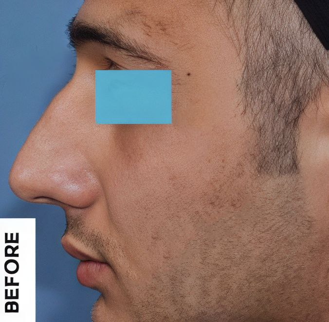 جراحی زیبایی بینی